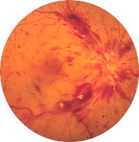 ocular rosacea.jpg