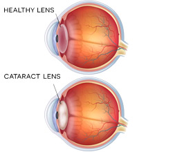 Cataract Comparison